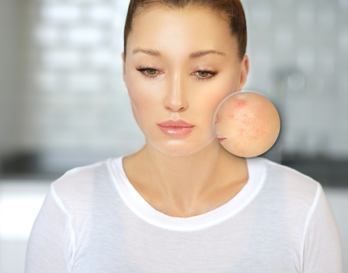 Uneven skin texture and acne scars treated with chemical peels