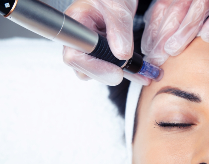Microneedling Skin Rejuvenation: Benefits, Process & Results