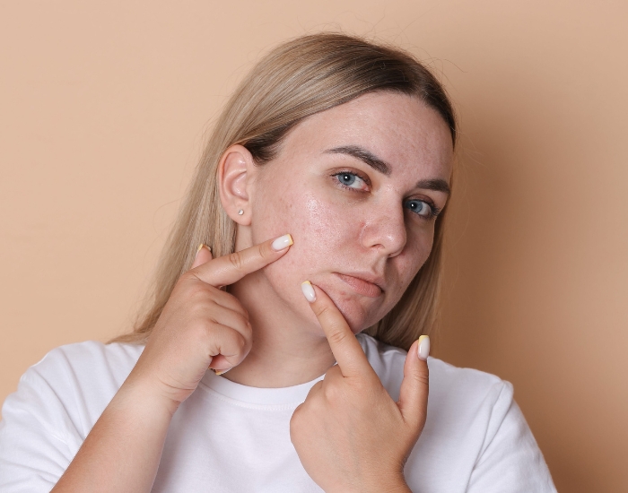 Best Treatment for Acne Scars | Top Solutions & Skin Care