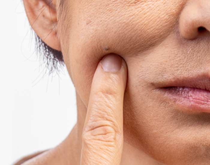 Tighten Sagging Skin Without Surgery | Best Non-Surgical Options