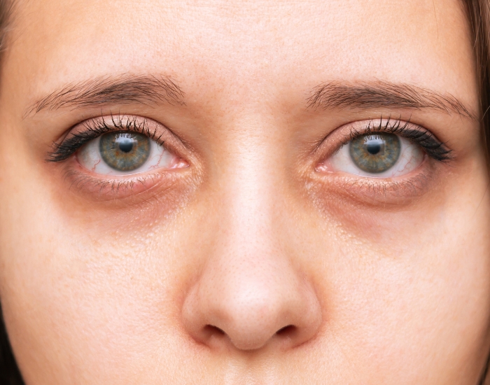 Dark Circles Under Eyes Treatment – Causes & Solutions